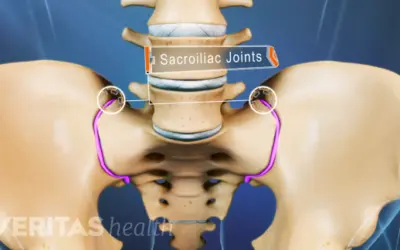 Are you suffering from Sacroiliac Joint (SI Joint) Pain?