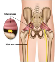What is Piriformis Syndrome?